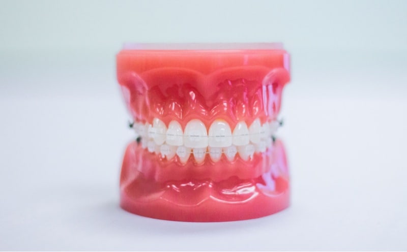 ceramic braces on model