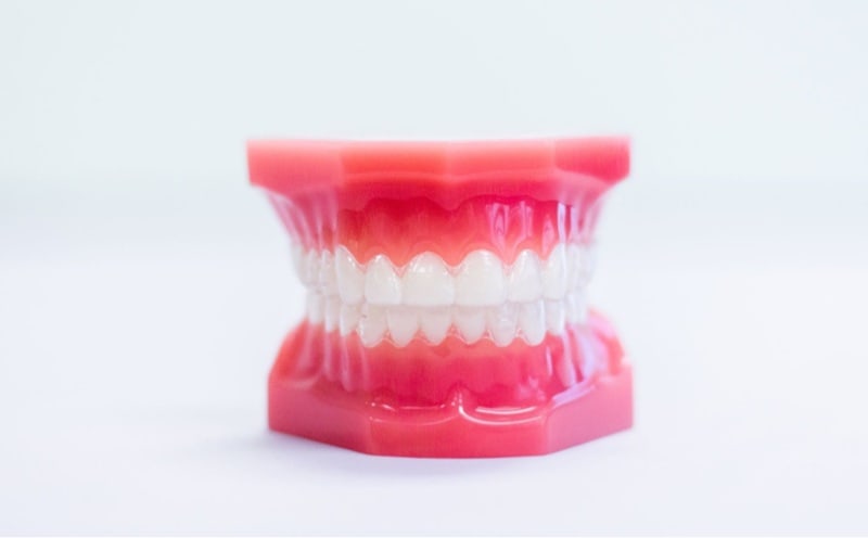 invisalign aligners on model